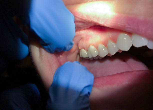 Best Knocked-Out Tooth (Avulsed Tooth) Treatment in Lake Park, FL